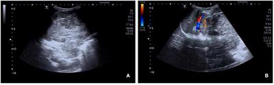 Retroperitoneal alveolar rhabdomyosarcoma intruding into spinal canal: A case report and literature review